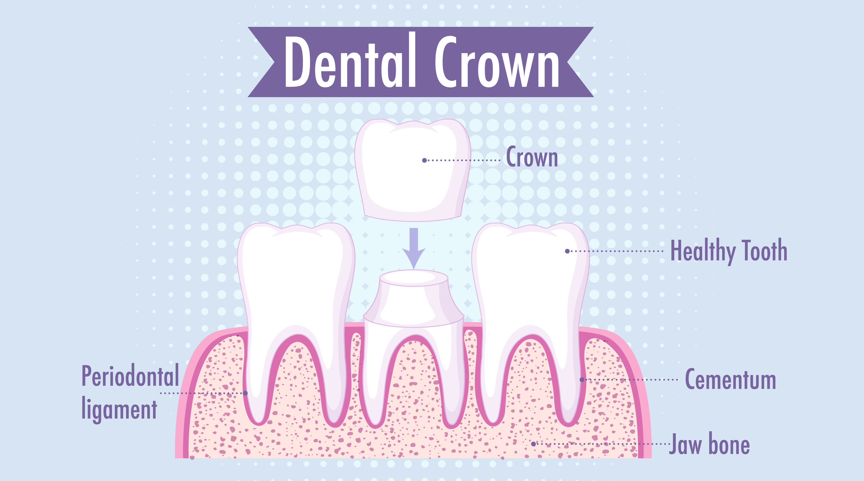Dental Crown