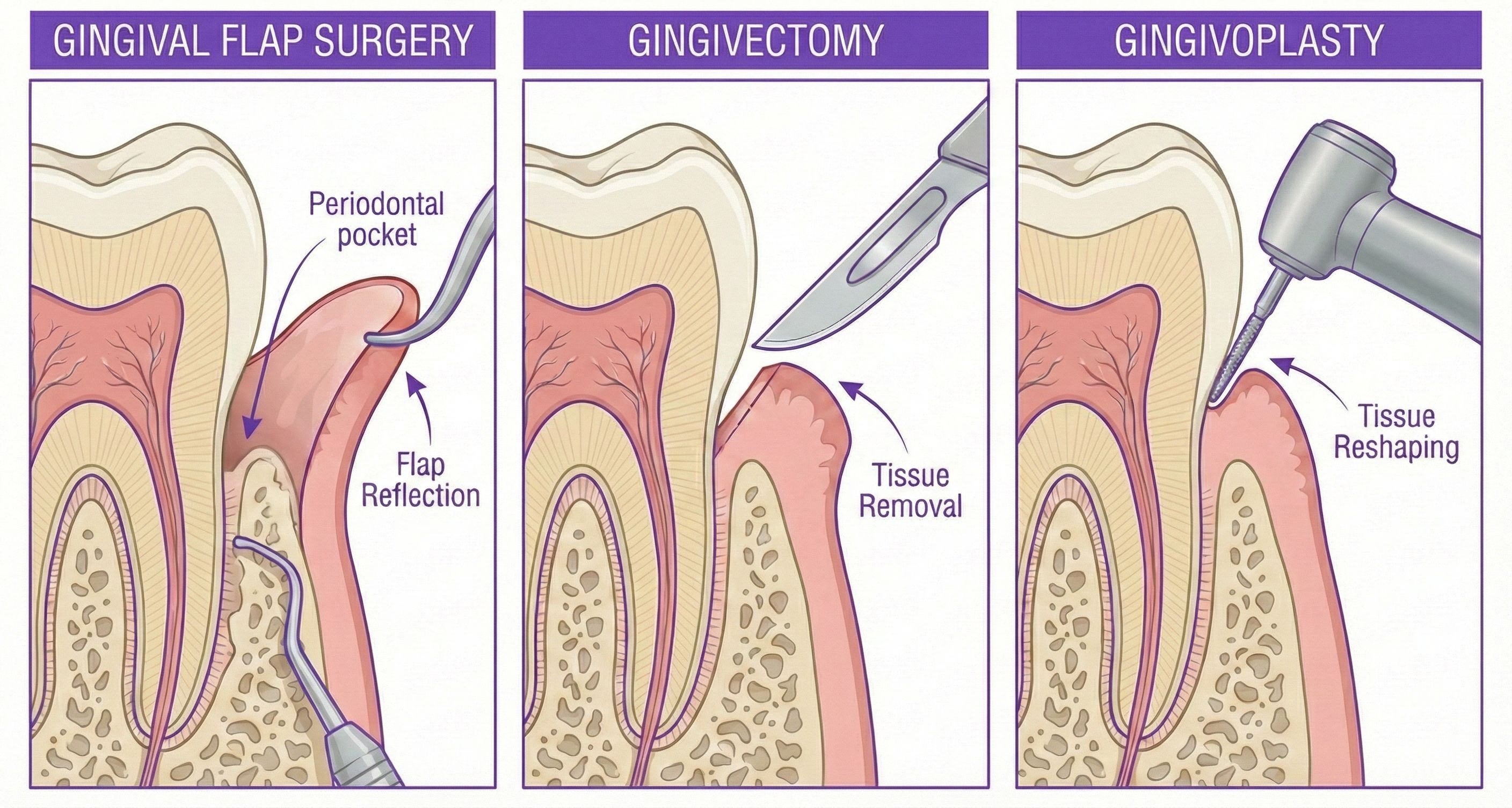 Gum Surgery